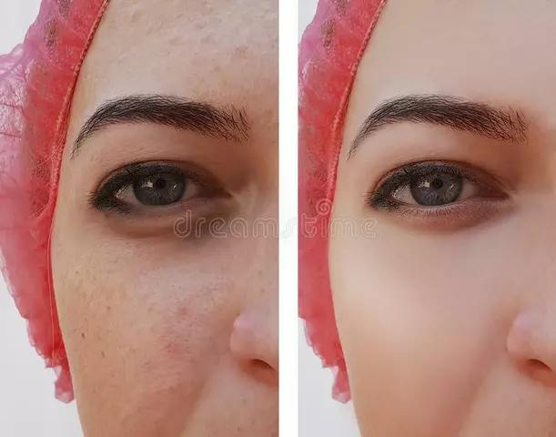 How to Reduce Eye Swelling caused by Cosmetic Procedures