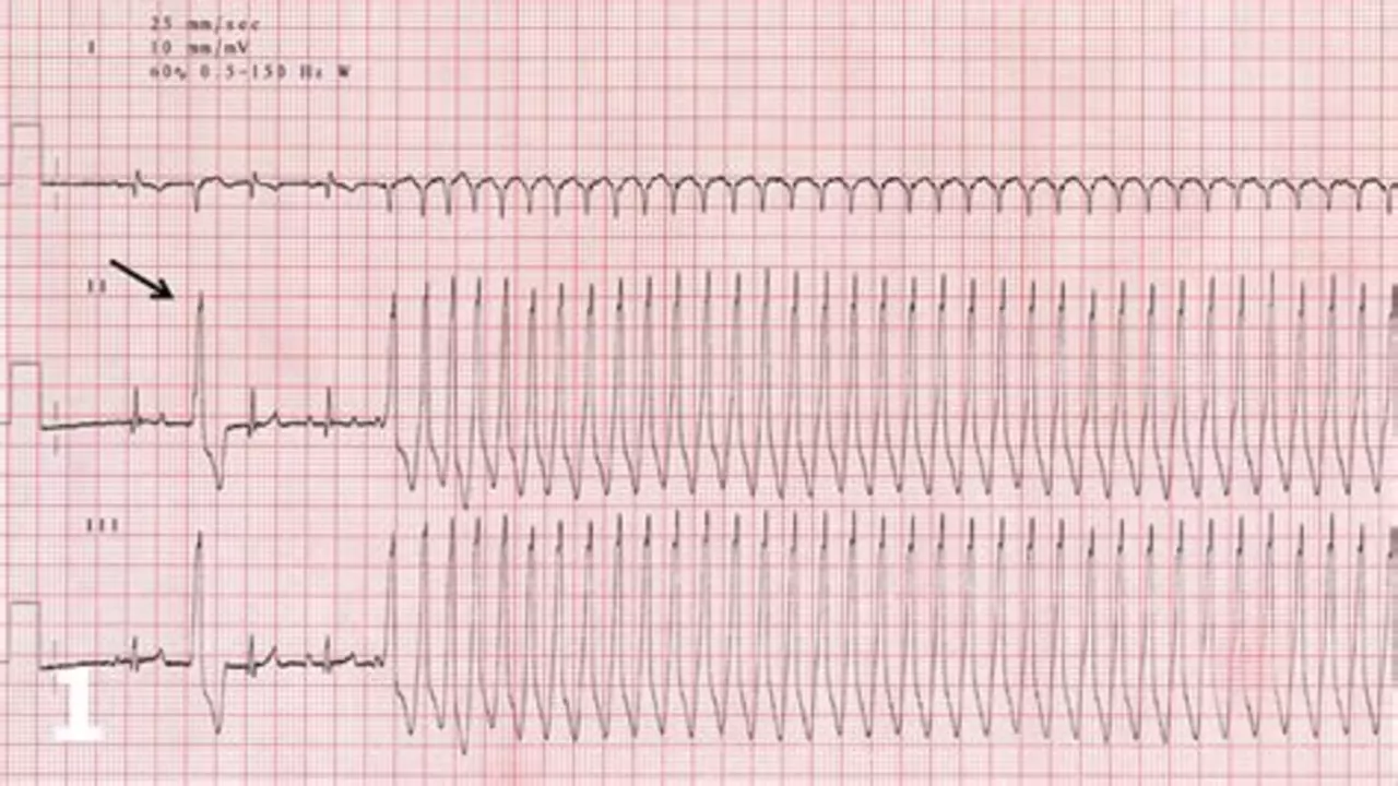 Supraventricular Tachycardia in Athletes: Risks, Symptoms, and Management